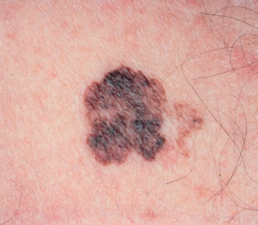 type of skin cancer.